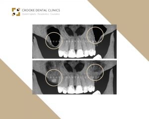 Breast augmentation 1