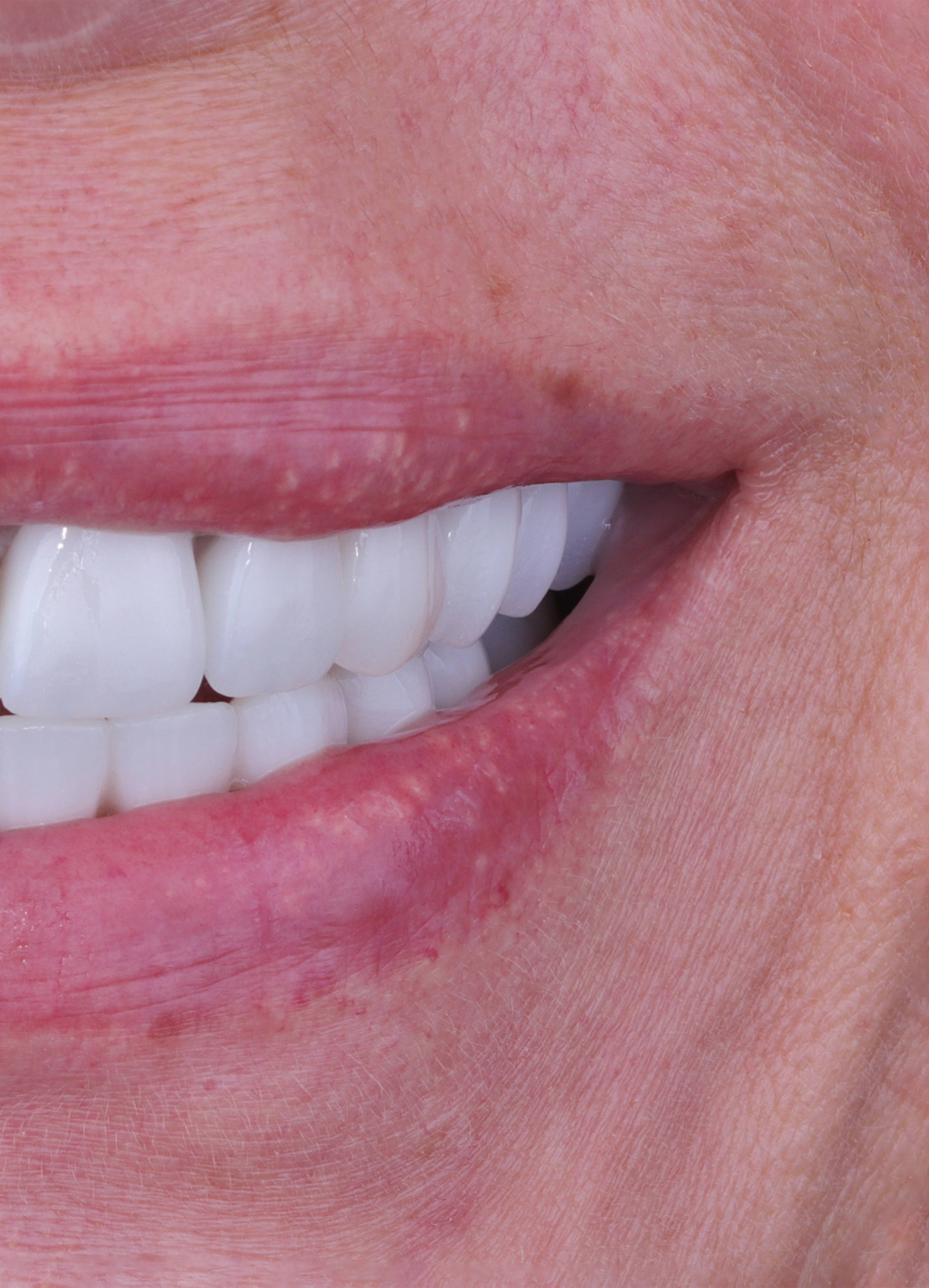 Carillas guiadas con minima preparacion Carillas guiadas con minima preparacion