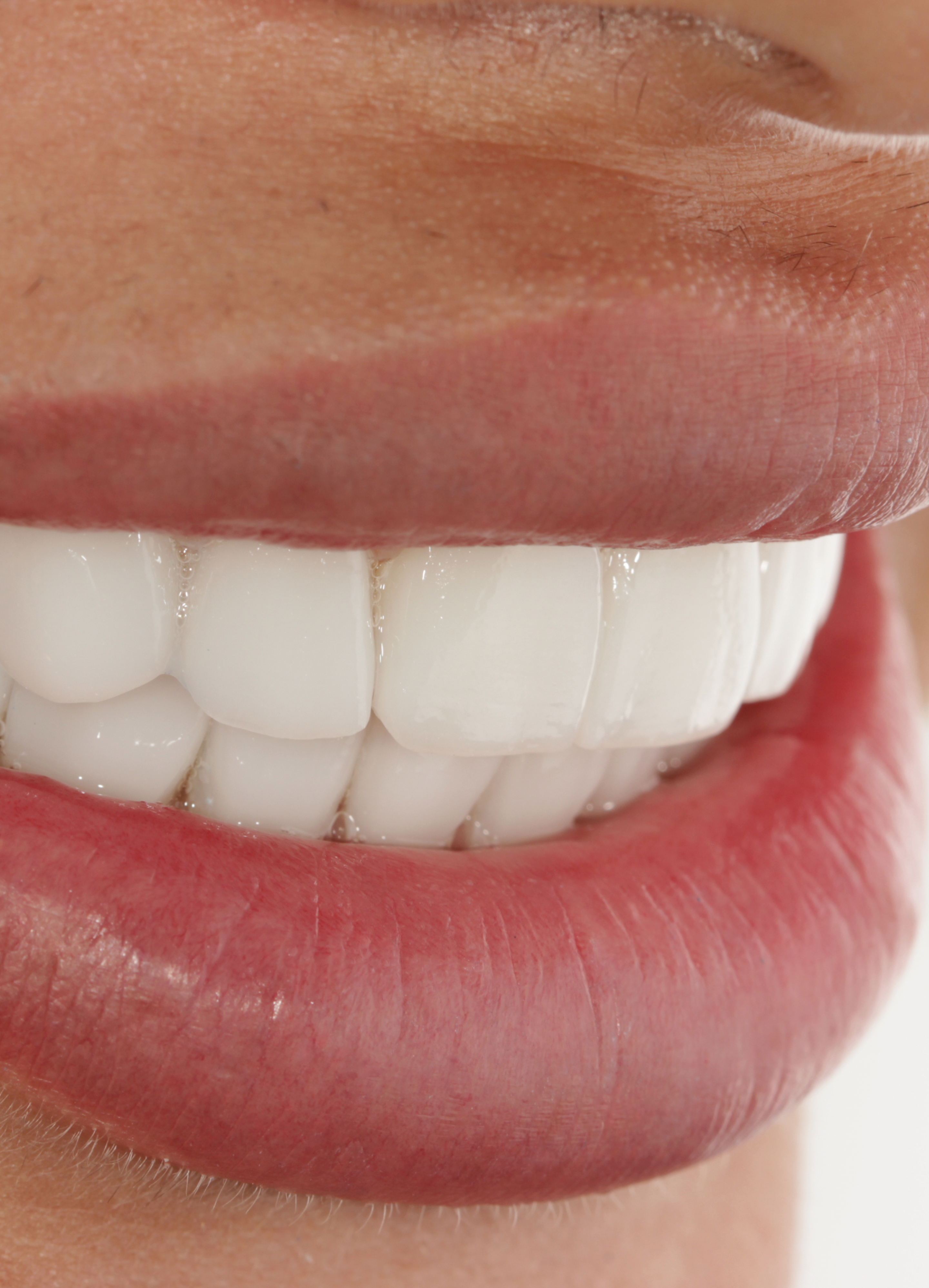 Carillas de porcelana de cerca Carillas de porcelana de cerca