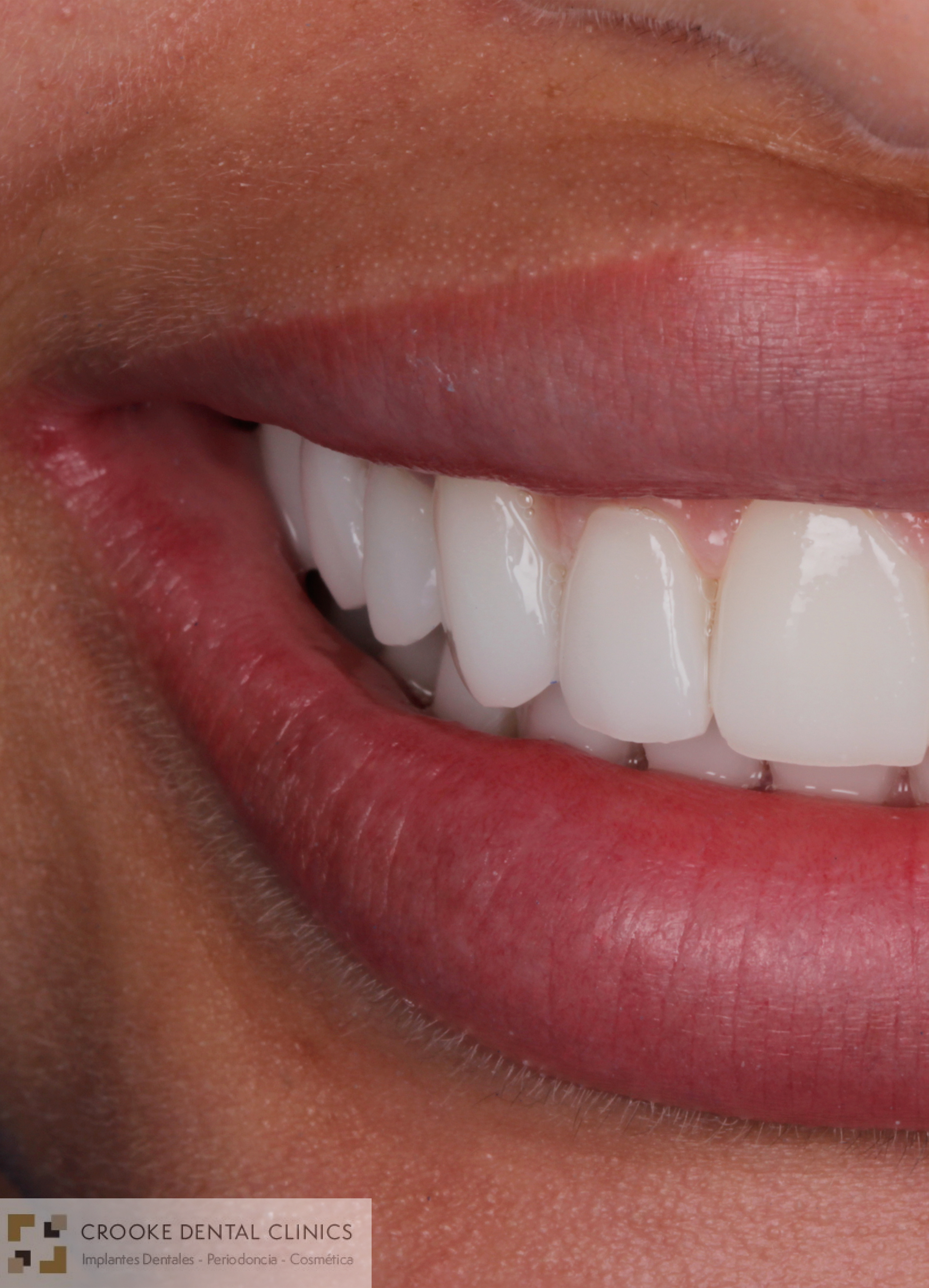 carillas guiadas de porcelana 2 carillas guiadas de porcelana 2