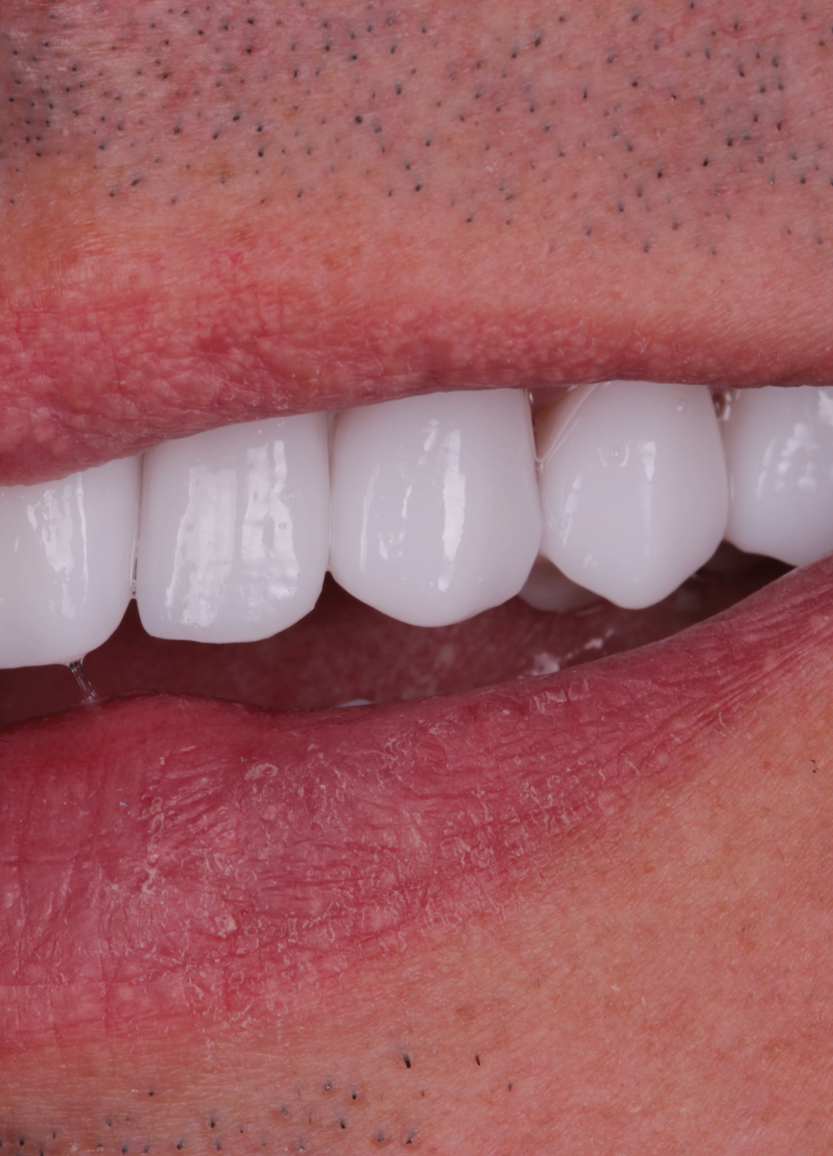 Consigue Alinear los lados de tu sonrisa sin esfuerzo Consigue Alinear los lados de tu sonrisa sin esfuerzo