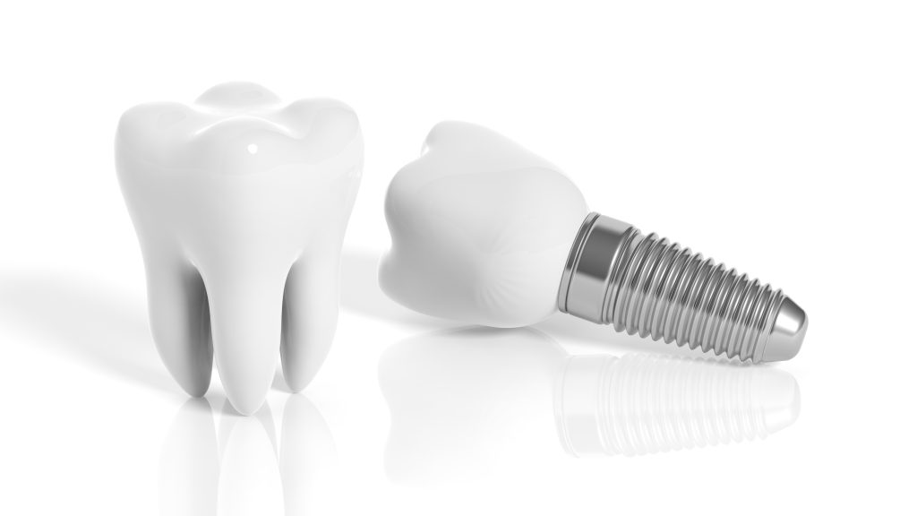 tooth implant