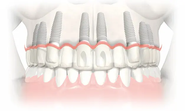 rehabilitacion-sobre-implantes
