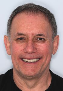 Combined Implant and Aesthetics Case