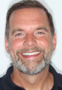 Combined Implant and Aesthetics Case