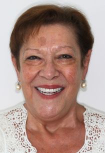 Full Mouth Zirconia Dental Implants