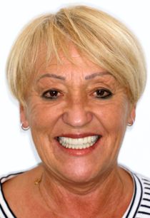 Full Mouth With Bone Regeneration