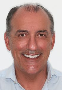 Full Mouth Dental Implants