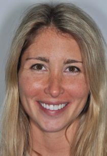 Orthodontics and Veneers