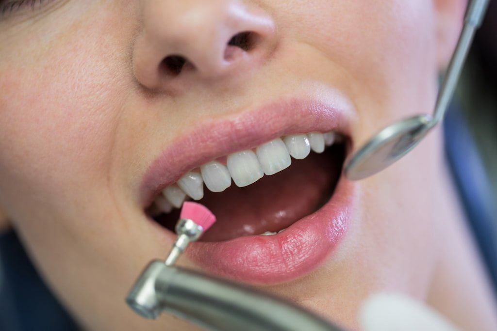 diferencia curetaje y limpieza dental