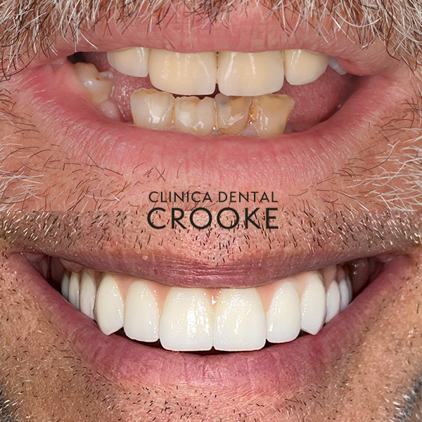 Case of dental implant without bone