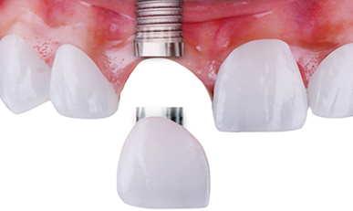 Dental Implants - Single Implants