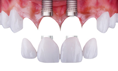 Dental Implants - Dental Bridges