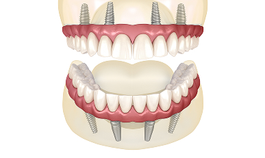 Dental Implants - Restorations