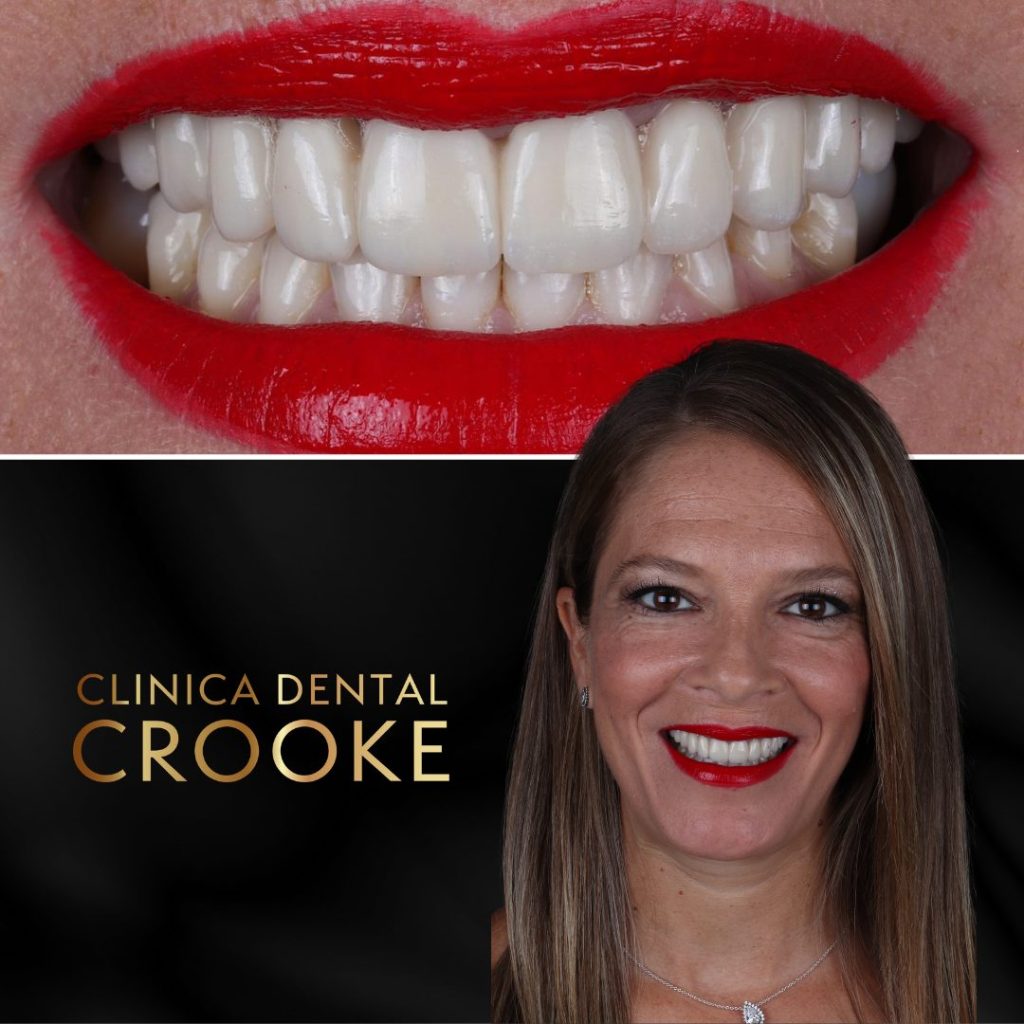 tratamiento de dientes fijos en 24 horas