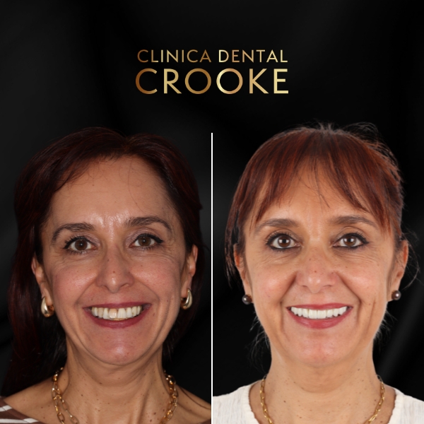 Rehabilitaciones completas y parciales